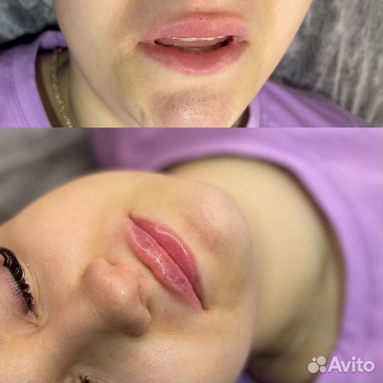 Аугментация губ