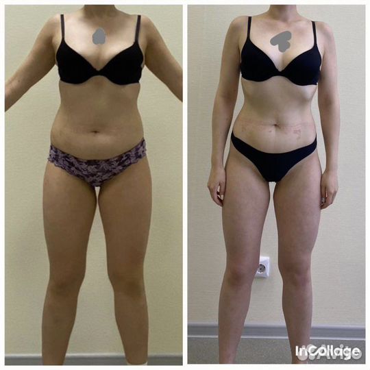 Вакуумно-роликовый массаж тела