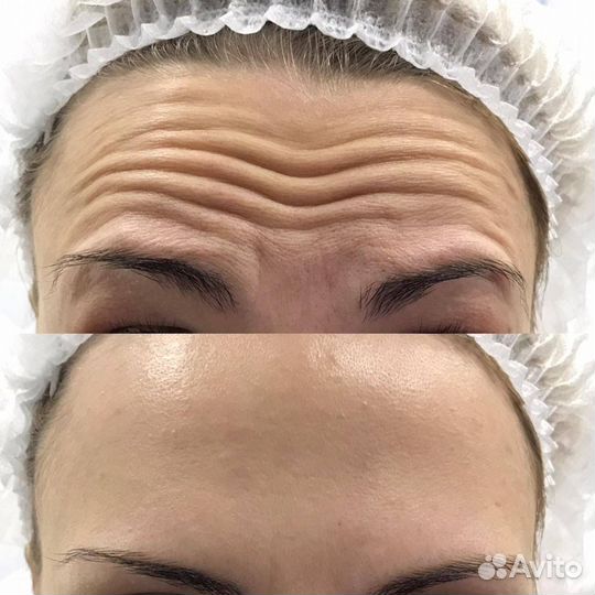 Модель на ботокс лица