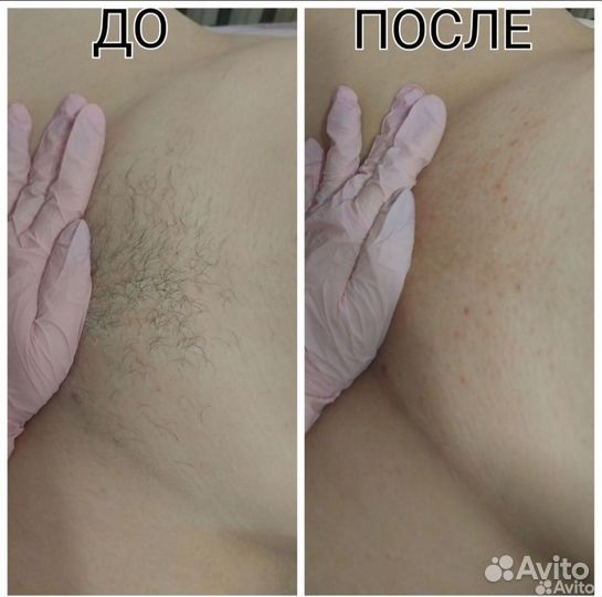 Восковая депиляция