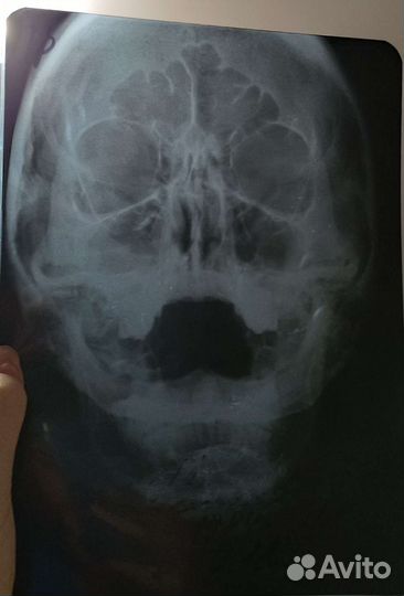 2 рентгеновских снимка