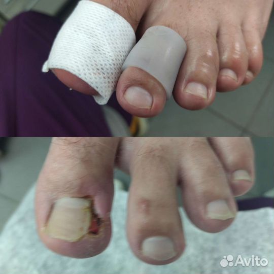 Медицинский педикюр подолог. Выезд на дом