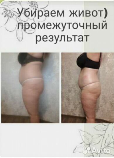 Коррекция фигуры: липосакция, кавитация и массажи