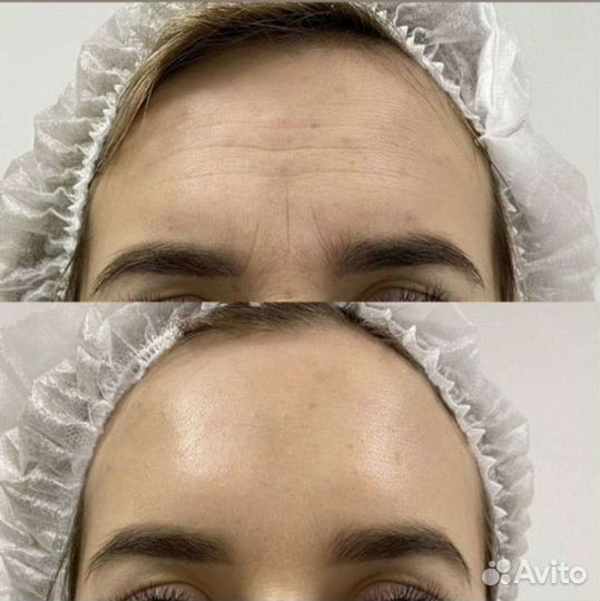 День ботокса Релатокс