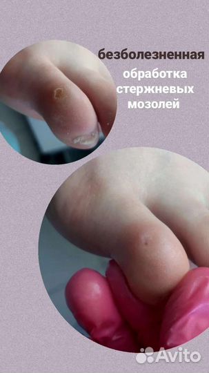 Педикюр / подолог