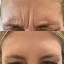 Ботокс Full Face, Видное