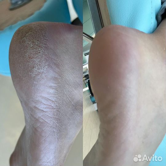 Смарт педикюр в Туле