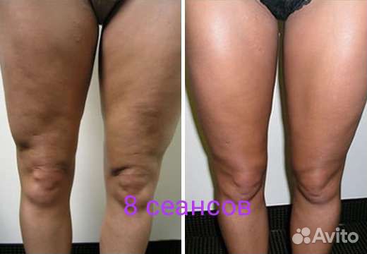 Антицеллюлитный массаж