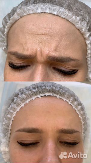 Ботокс лица