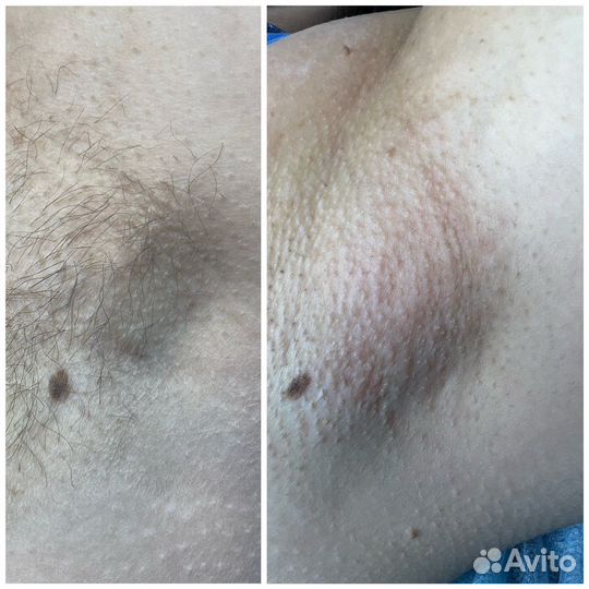 Электроэпиляция: голени