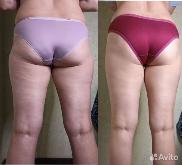 Массаж липопластика лица и тела