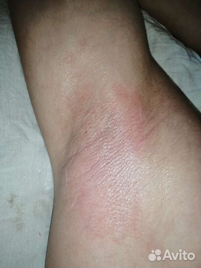 Депиляция воском: глубокое бикини