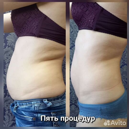 Шугаринг, коррекция фигуры