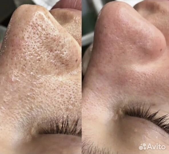 Чистка лица, пилинги, биоревитализация