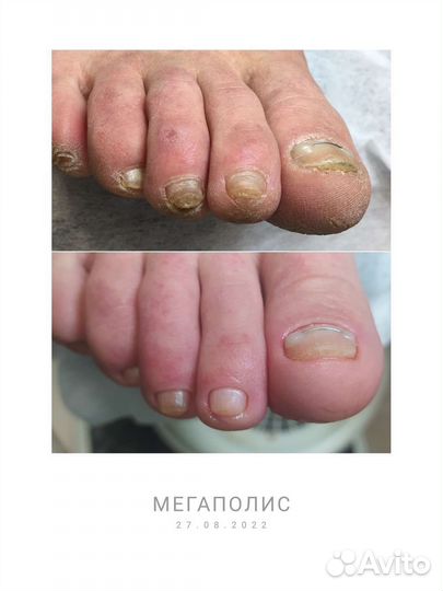 Мед. Педикюр1500/Титан1500