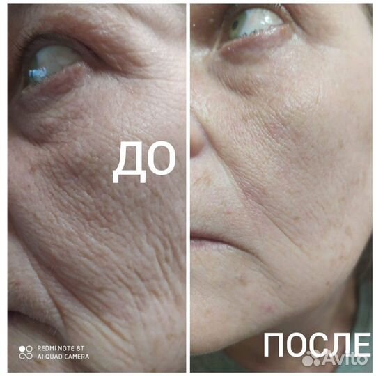 RF-лифтинг. Аппаратная косметология