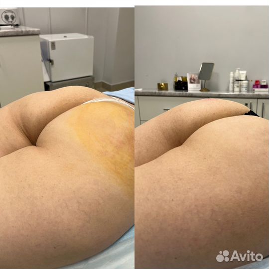 Увеличение ягодиц