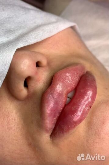 Биоревитализация