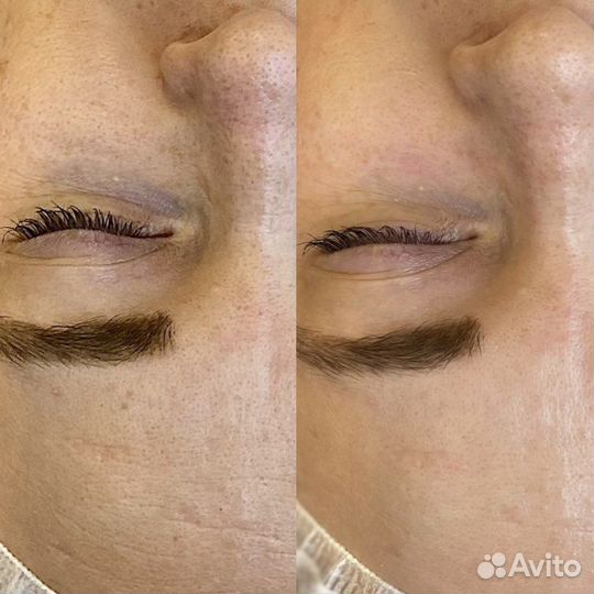 Карбокситерапия