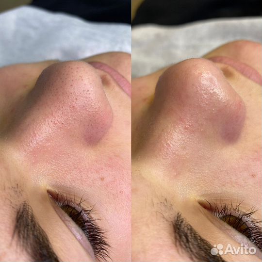 Врач-косметолог: чистка лица, бта, увеличение губ