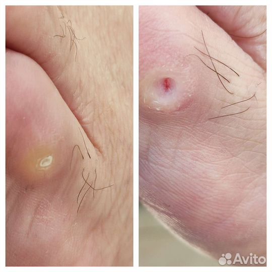 Медицинский педикюр/ подолог