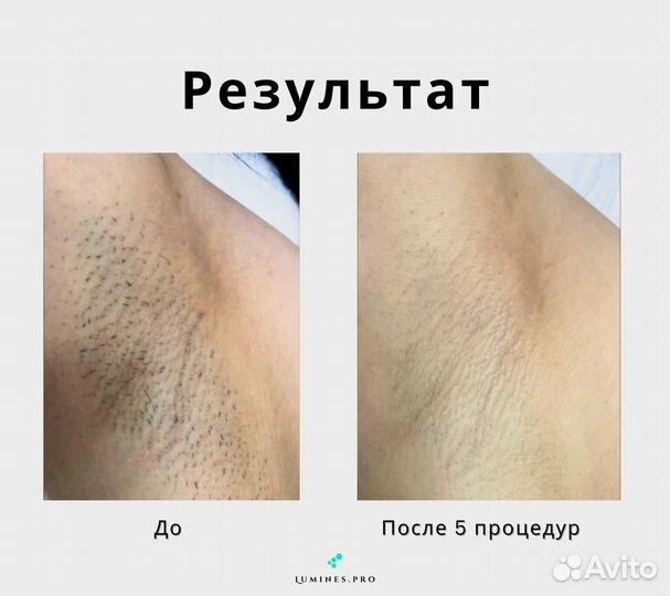 Аппарат для эпиляции Лю-Минес Макс Ван 1200в