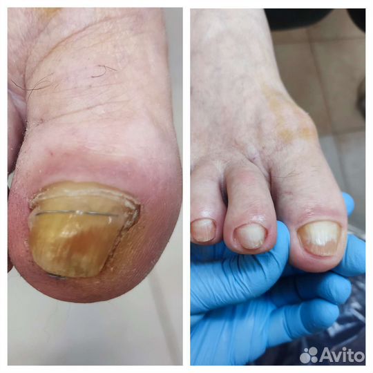 Медицинский педикюр/ подолог