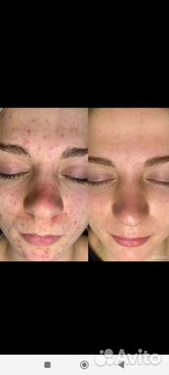 Аппаратная косметология холодная плазма