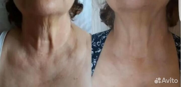 Биоревитализация мезотерапия губы