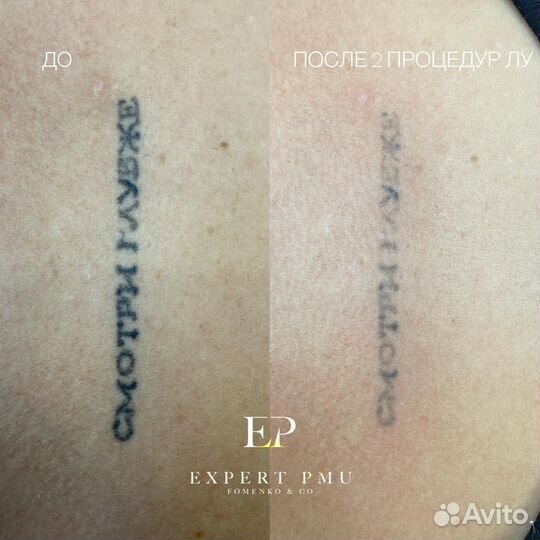 Лазер для удаления тату и татуажа Alpha+