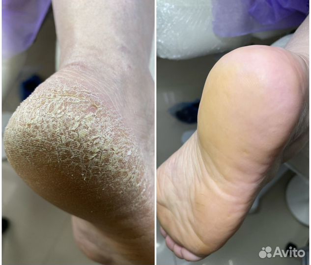 Педикюр smart