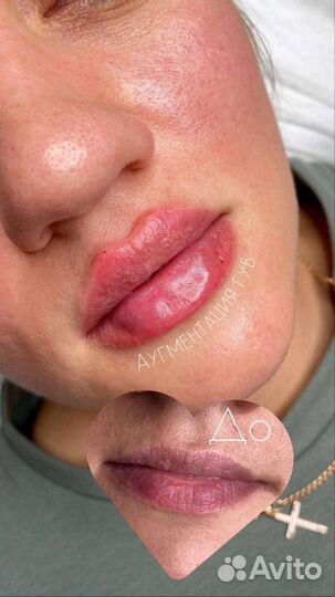 Инъекции ботокса в лоб