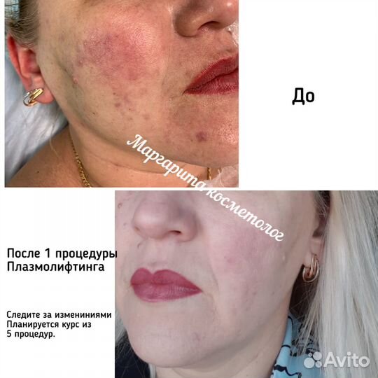 Косметолог/Челны/Плазмолифтинг/Плазмогель