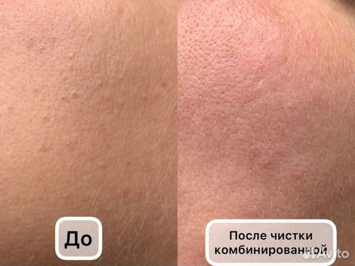 Чистка лица. За 1 час чистое лицо без последствий