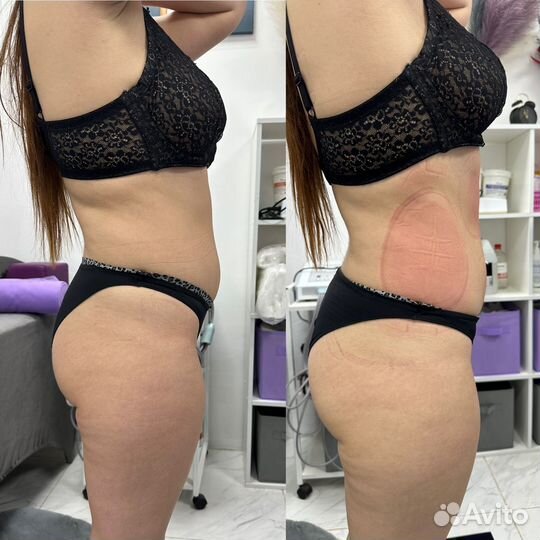 Аппаратная коррекция фигуры