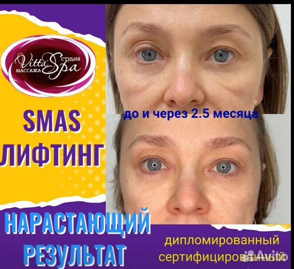 Безоперационная блефаропластика век