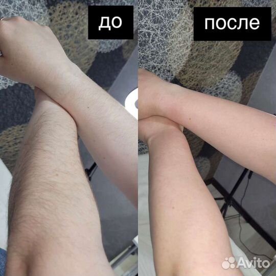 Депиляция