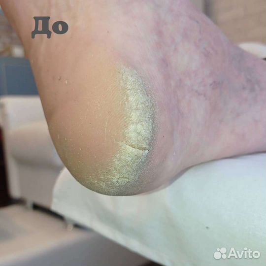 Педикюр, парамедицинский педикюр