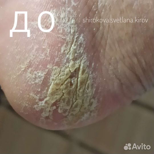 Маникюр Педикюр Деформация ногтей Мозоли Трещины