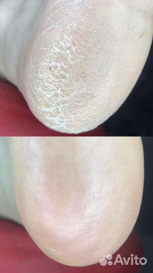 Услуги подолога / педикюр