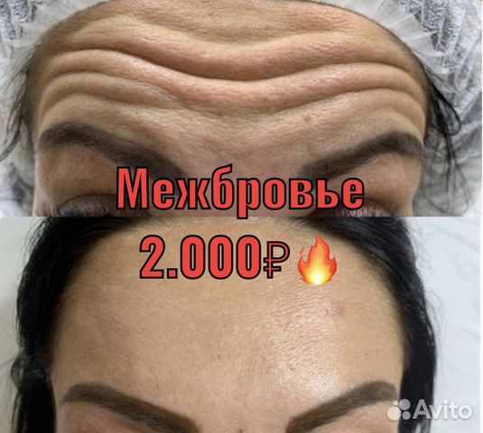 Ботокс ботулинотерапия лечение гипергидроза
