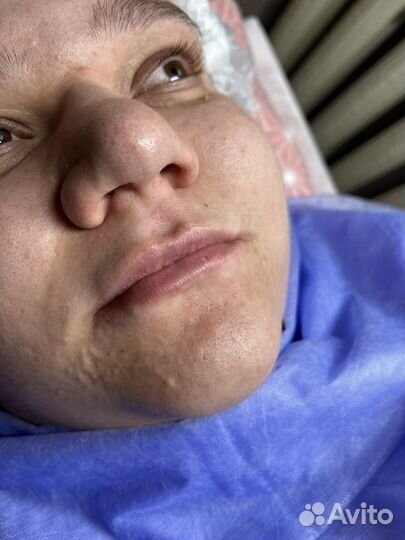 Контурная пластика