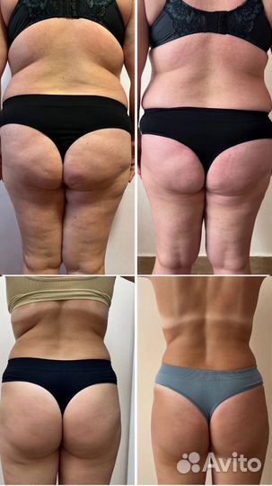 Аппаратный массаж, коррекция фигуры, похудение