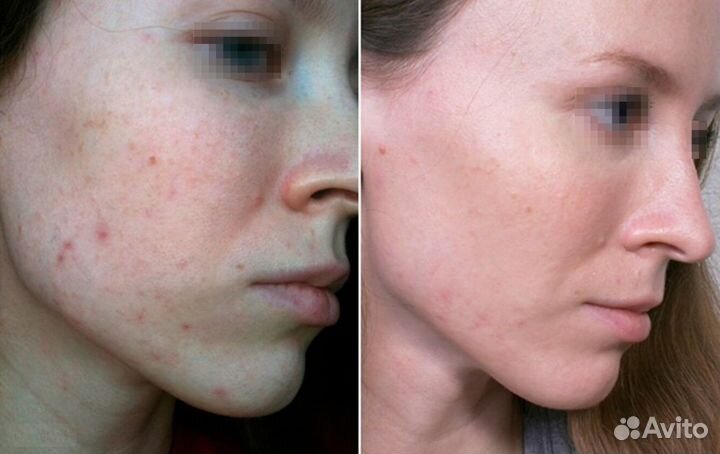 Лечение акне и постакне аппаратное