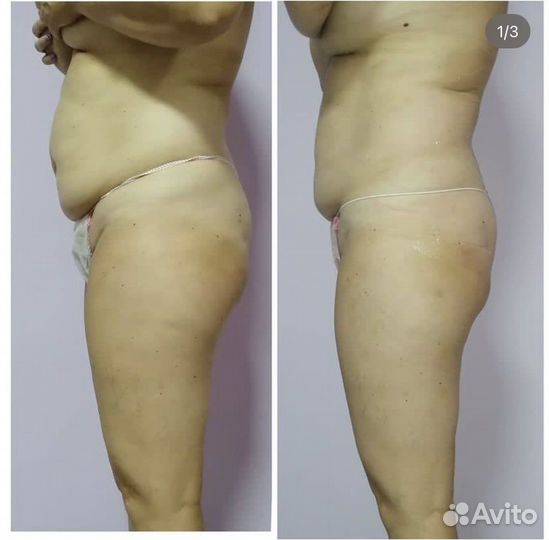 Массаж. Коррекция фигуры