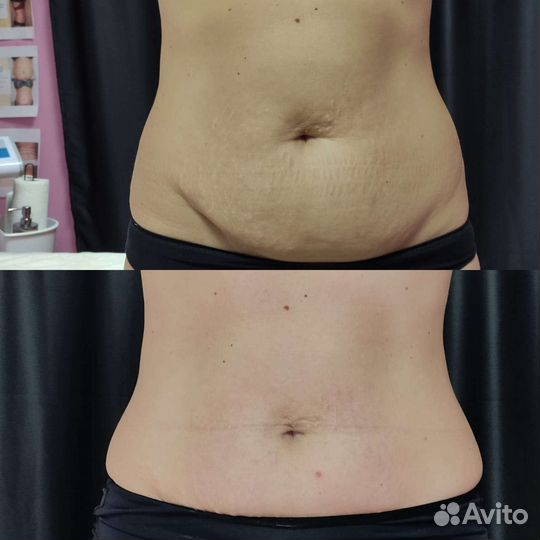 Вакуумный массаж, РФ- лифтинг, кавитация