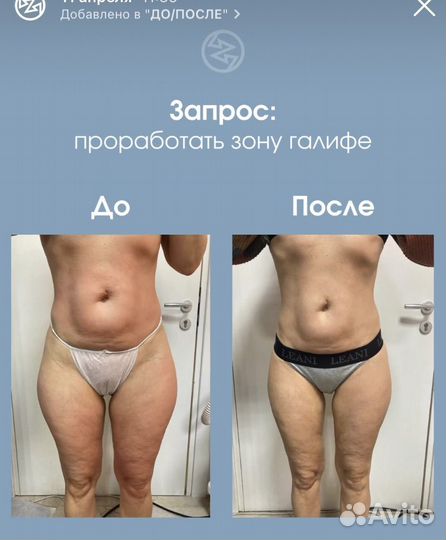 LPG массаж + доп процедуры