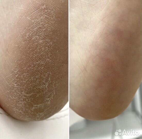 Подолог.Вросший ноготь.Грибок.Мозоль.Бородавки