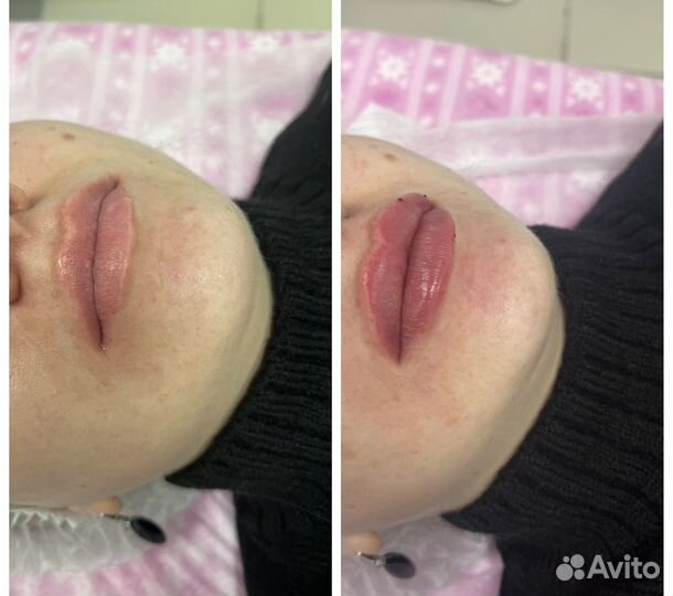 Увеличение губ