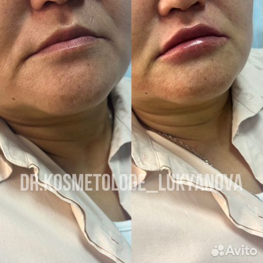 Увеличение губ Контурная пластика